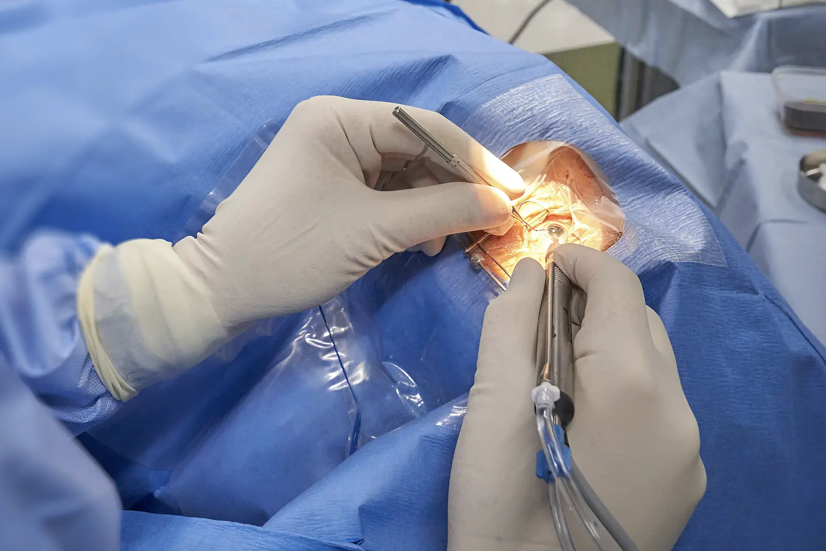 Laserbehandlungen-Augenarzt Laserbehandlungen-Augenarzt